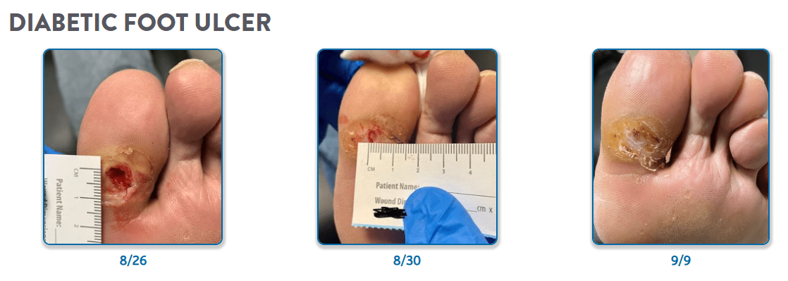 Diabetic Foot Ulcer Progress