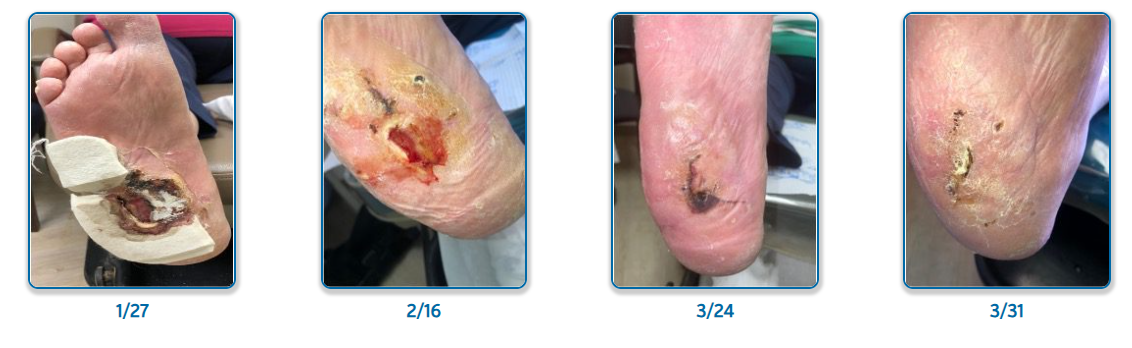 Diabetic Foot Ulcer with Charcot Progress