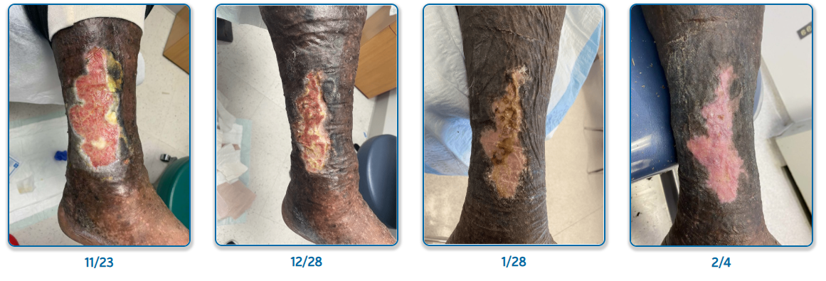 Venous Leg Ulcer Progress